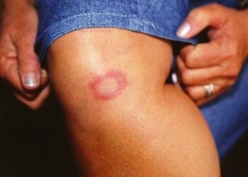Ainda cercada de preconceito, hanseníase tem cura se tratada da maneira adequada