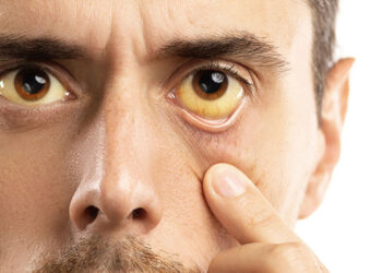 Causadas por diferentes fatores, a maioria das hepatites são assintomáticas