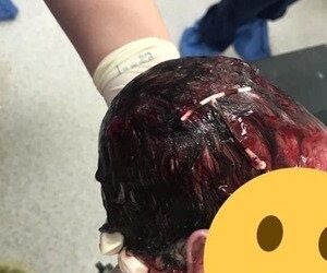 Bebê nasce com DIU pendurado na cabeça e reacende eficácia de métodos contraceptivos