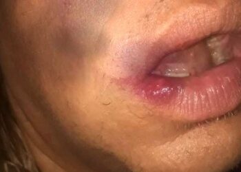 Travesti é agredida ao sair com amigas e registra caso na polícia como homofobia