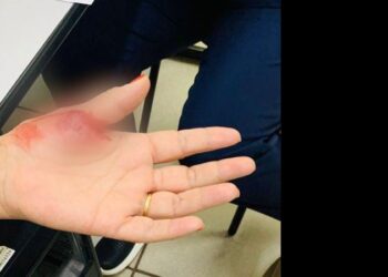 Técnica de enfermagem é mordida na mão por filha de paciente em UPA da Capital