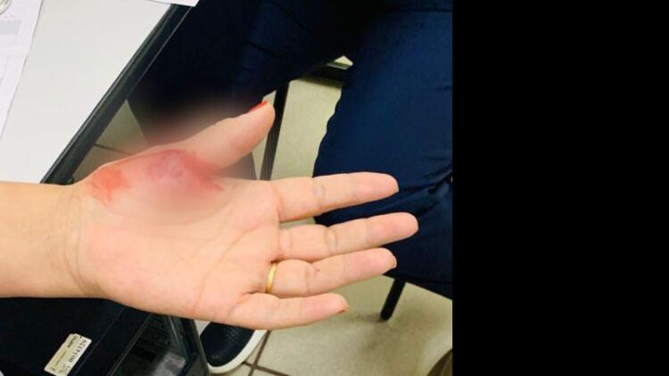 Técnica de enfermagem é mordida na mão por filha de paciente em UPA da Capital