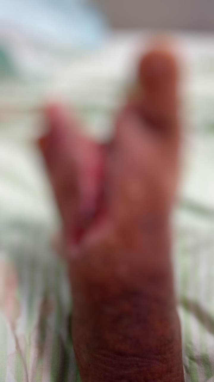 Amigos recorrem à vaquinha para que Elisângela não tenha que amputar os pés