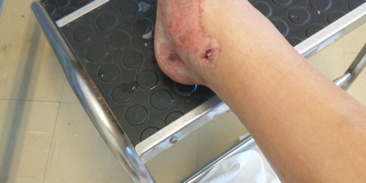 Família pede ajuda para cuidar de menina, após motorista a atropelar e fugir na Capital