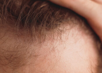 Usada para combater a calvície, finasterida tem efeitos colaterias reduzidos nas versões gel e spray