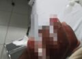Em bar, ex-padrasto tenta acertar cabeça com facão e decepa o dedo do ex-enteado