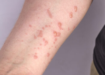 Para combater a Monkeypox, SES cria centro de operações de emergência e realiza primeira reunião