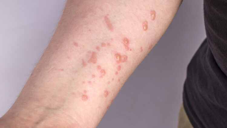 Para combater a Monkeypox, SES cria centro de operações de emergência e realiza primeira reunião