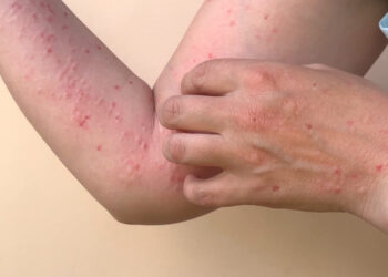 Teste PCR para confirmação de diagnóstico da Varíola dos Macacos já está disponível