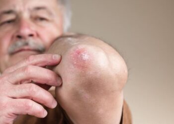 Com tratamento integral pelo SUS, Hanseníase é doença grave que tem cura