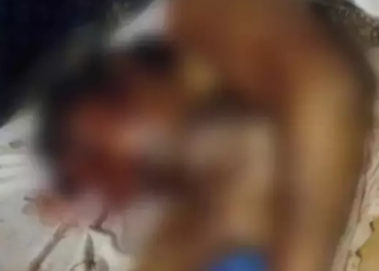 Mulher tem rosto desfigurado e perde um olho, após ser agredida por marido em MS