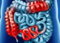 Especialista explica o que é a Doença de Crohn!