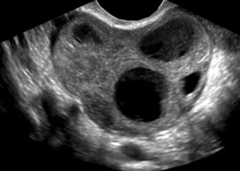 Endometriose pode diminuir em média de 10 horas semanais da produtividade da mulher