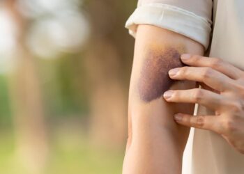 Leucemia: fique atento a esses 6 sinais!