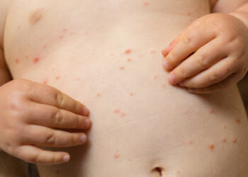 Mato Grosso do Sul livre de sarampo: marco nacional rumo à eliminação da doença