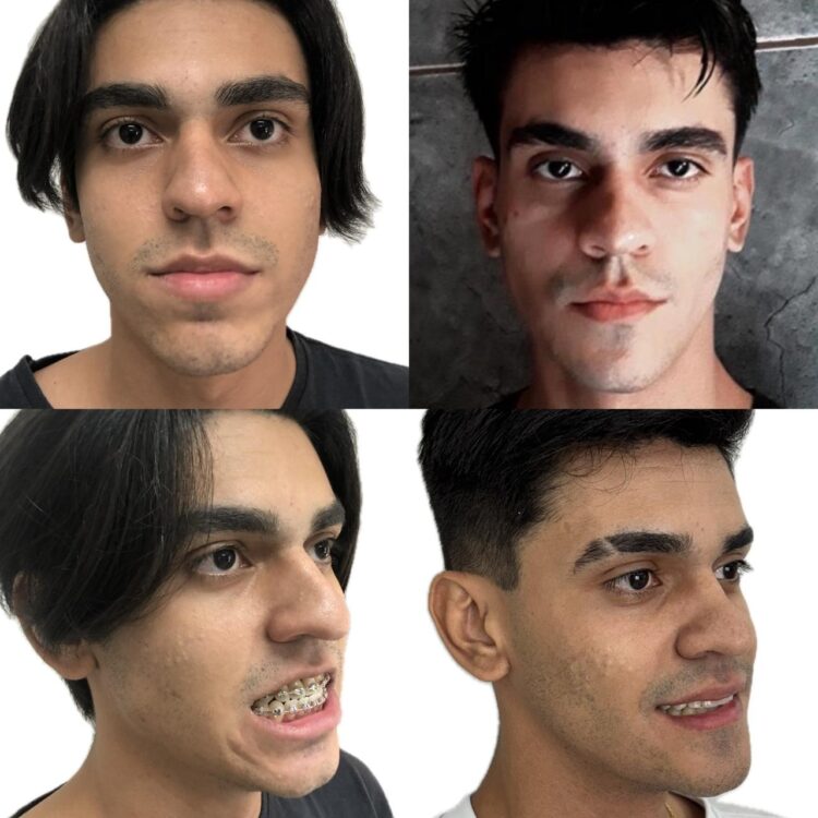 ABO/MS lança projeto para pacientes com indicação de cirurgia ortognática em Campo Grande