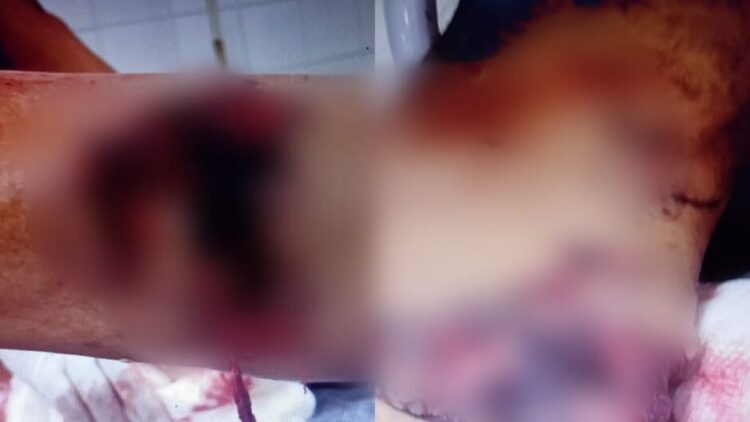 Pitbull ataca homem em chácara do Indubrasil e fere gravemente pernas e um dos braços