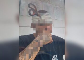 Em brincadeira de “croc”, rapaz acaba com tesoura cravada na cabeça pela namorada em Água Clara